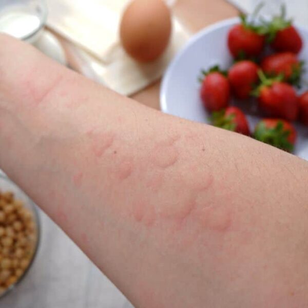 can you be allergic to strawberry plants but not strawberries