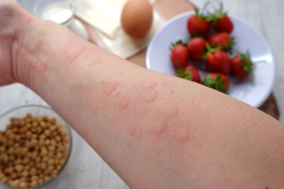 can you be allergic to strawberry plants but not strawberries